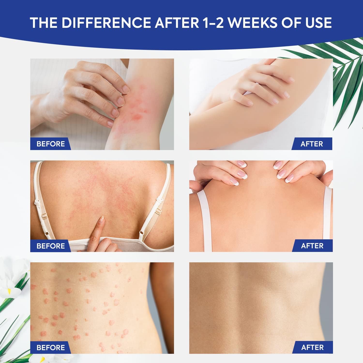 Anti fungal Cream for Skin: 3-in-1 Antifungal Cream Advanced Fast Acting Formula for Feet Body Groin - Athletes Foot Treatment and Jock Itch Ringworm Treatment for Humans 3.4 oz (100g) - Image 5