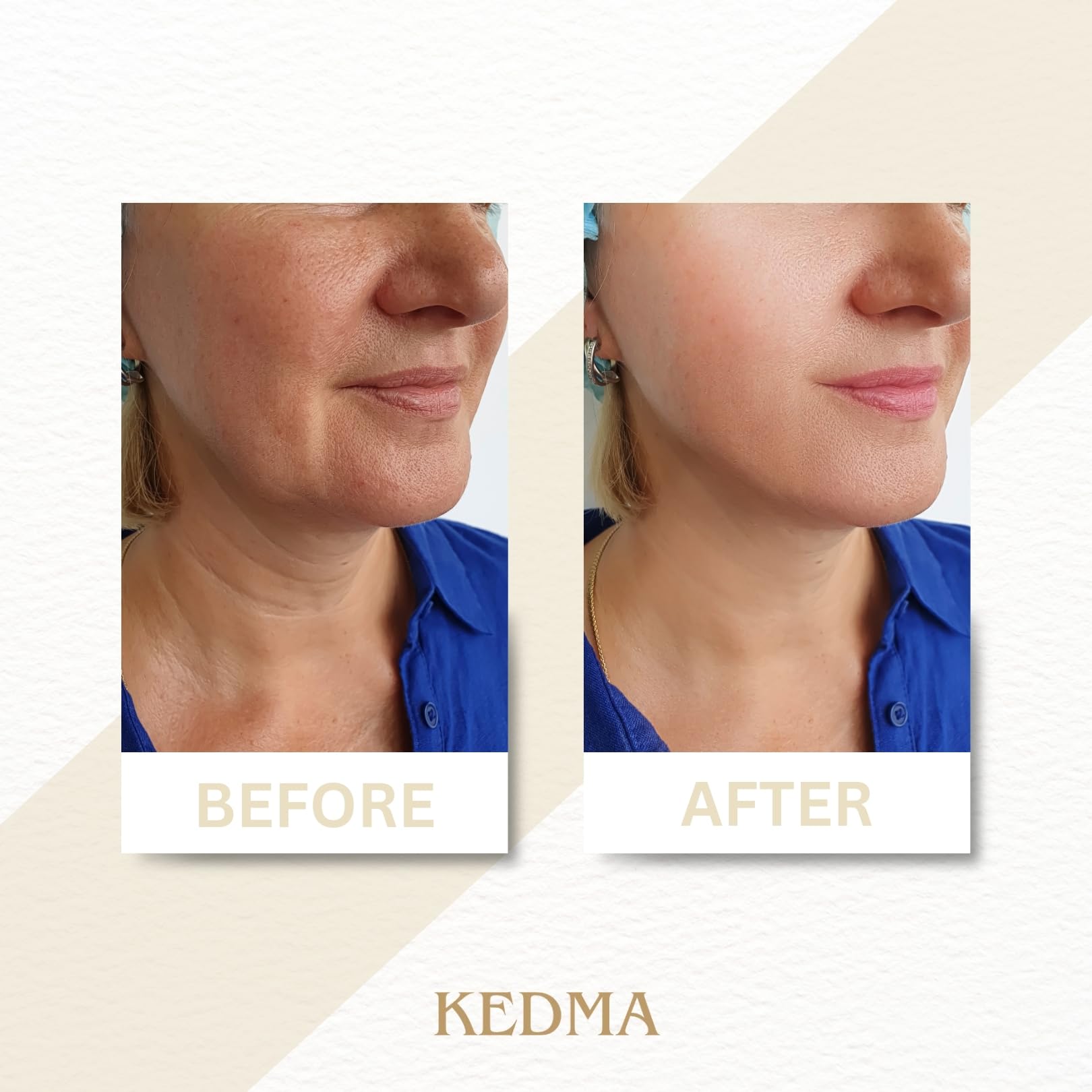 KEDMA - Crème Collagène Cou & Décolleté aux Minéraux de la Mer Morte - 50g | La crème au collagène hydrate le cou et le décolleté et aide à améliorer l’apparence de la fermeté.