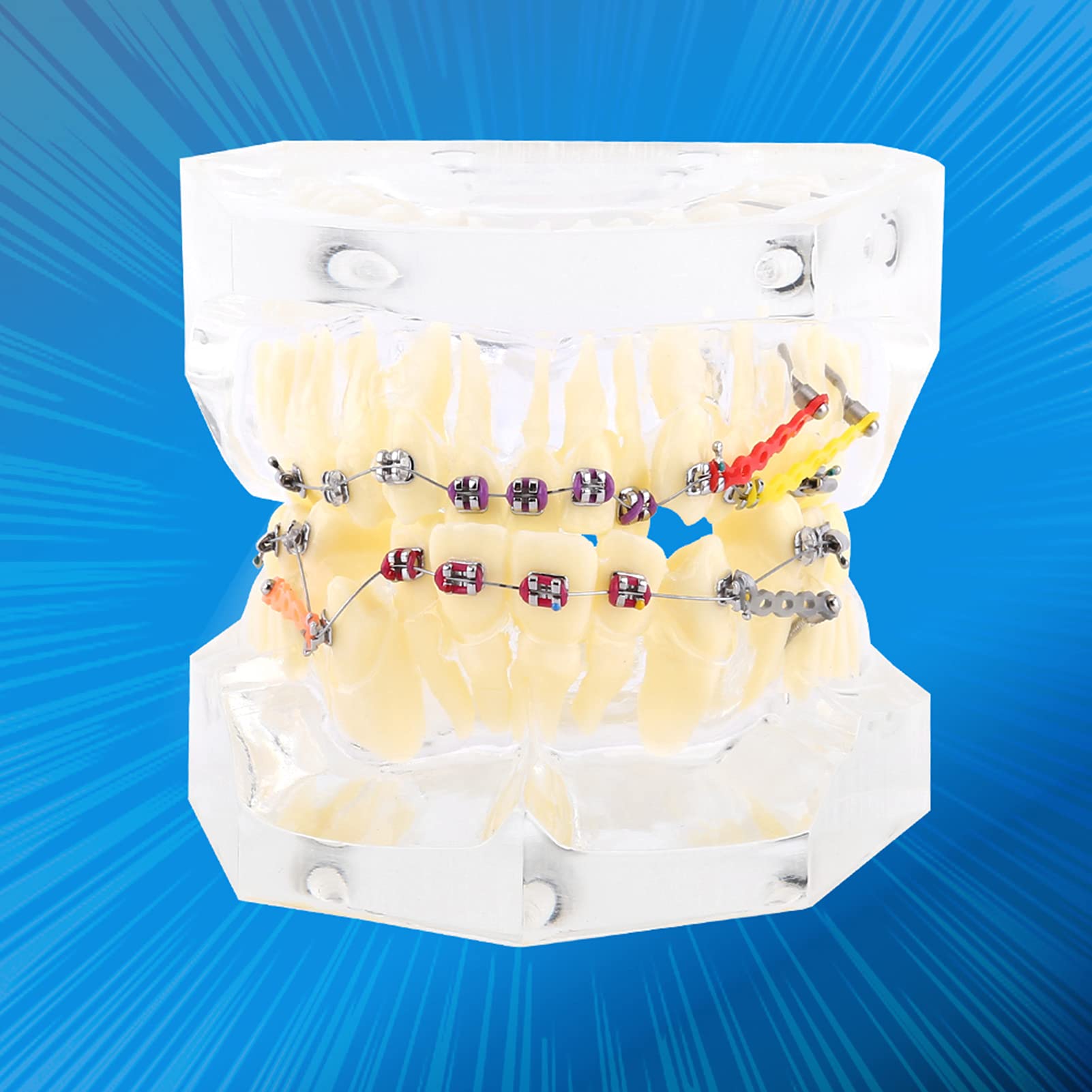 Staffe Ortodontiche, Modello di Denti Trattamento Ortodontico Dentale Studio di Malocclusione Modello di Denti con Staffe Dentali a Catena Metallica