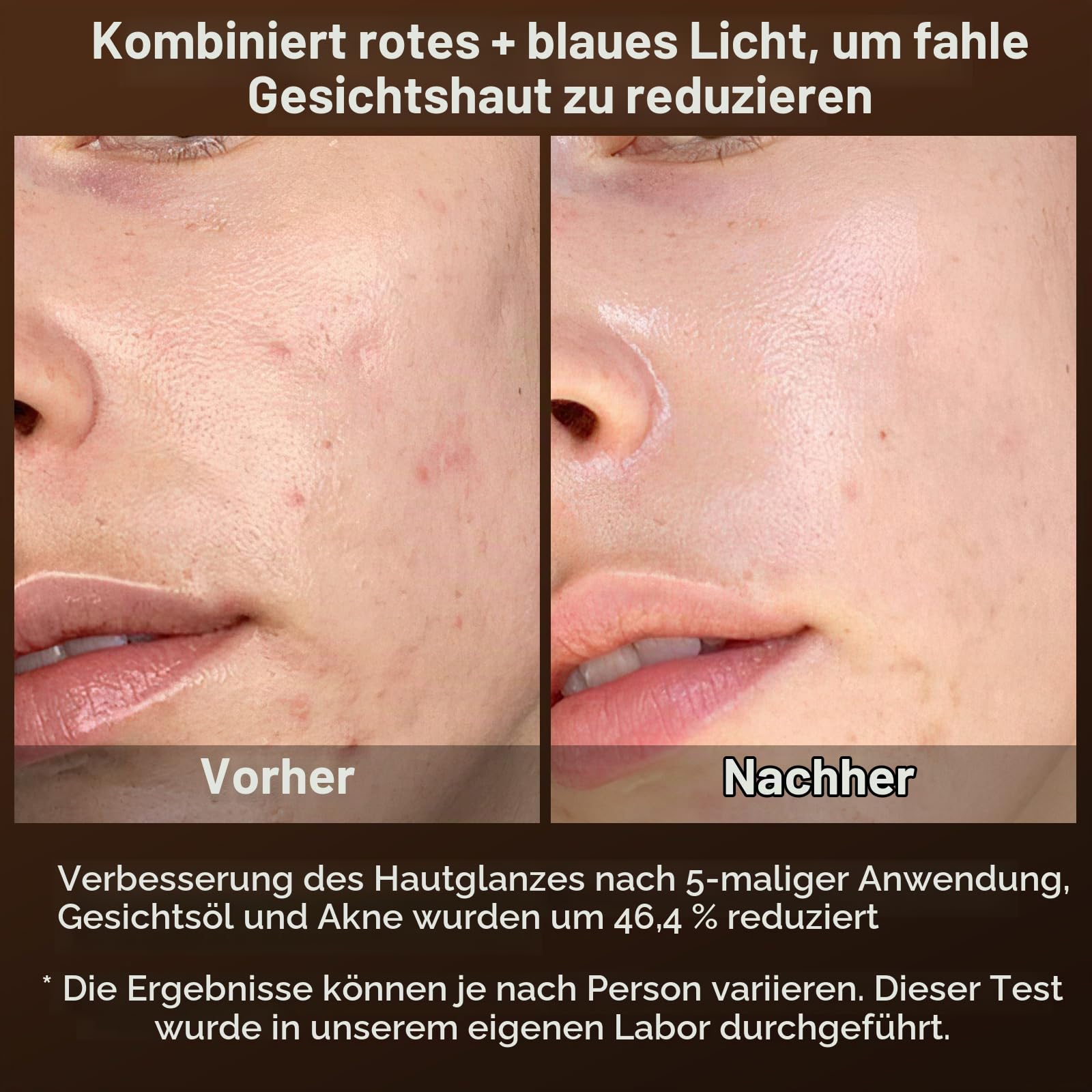 Radiofrequenz Gerät Gesichtsmassagegerät, 6 IN 1 EMS Gerät Gesicht Anti Aging Gesichts Massagegerät 3MHz RF Rotes blaues Licht, Gesichtsstraffungsgerät für Hautstraffung Hautpflege zu Hause