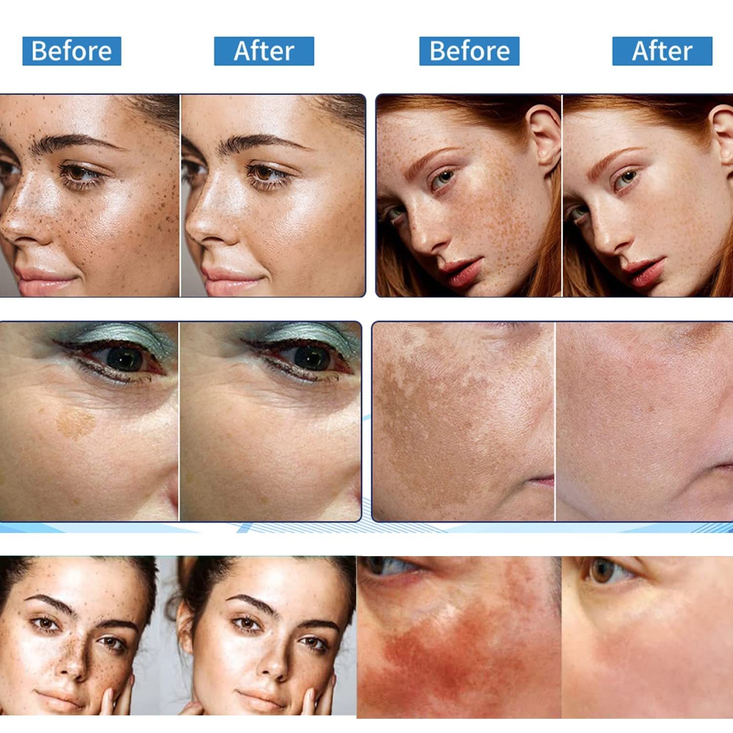 dark-spot-remover-for-face-hyperpigmentation-treatment-melasma
