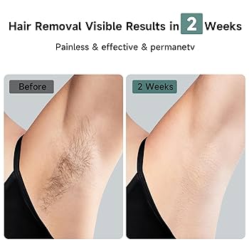 Amazon.com: JOVS Laser Hair Removal, 37°F Painless Hair
