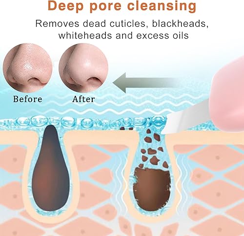 Miniatura 3 de Herramientas de eliminación de puntos negros, raspador de nariz para puntos negros, rascador de poros limpios, herramienta de limpieza profunda