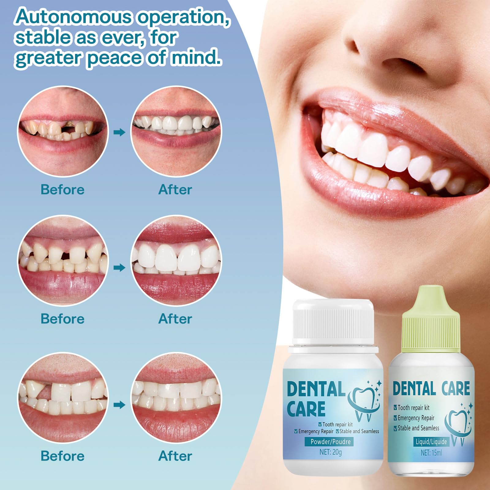 Cemento Dental Kit Reparación Relleno Temporal para Corona Puente Caries