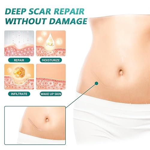 Miniatura 4 de Cinta de silicona para cicatrices quirúrgicas (rollo de 1.6 x 80 pulgadas, 6.6 ft), láminas de silicona de grado médico para cesáreas,