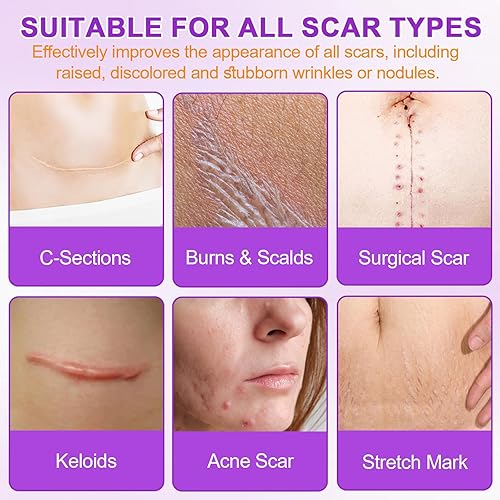 Miniatura 4 de Hojas de silicona para cicatrices, cinta de silicona para cicatrices (1.6 x 60 pulgadas), cinta de cicatriz de grado médico para cicatrices