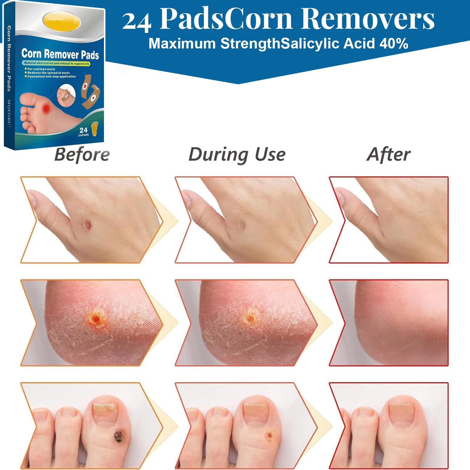 Quita Verrugas, 24 Parches para Verrugas Quitar, Eliminar Verrugas Plantares, Callos y Durezas, Tratamiento Suave para Niños y Adultos en Manos, Pies, Dedos, Cuello y Cara