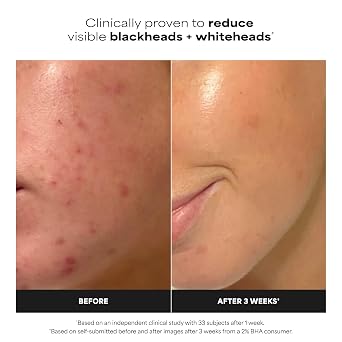 Paula's Choice SKIN PERFECTING 2% BHA Salicylic Acid Exfoliating Pads - Facial Exfoliant Pads for Blackheads, Enlarged Pores, Wrinkles & Fine Lines