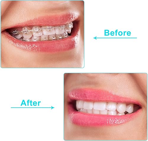 Miniatura 6 de Alineador de 100 piezas para Alineador de Alineador de Chompers Alineador de Ortodoncia para asientos, blanco, verde, naranja, rosa y morado