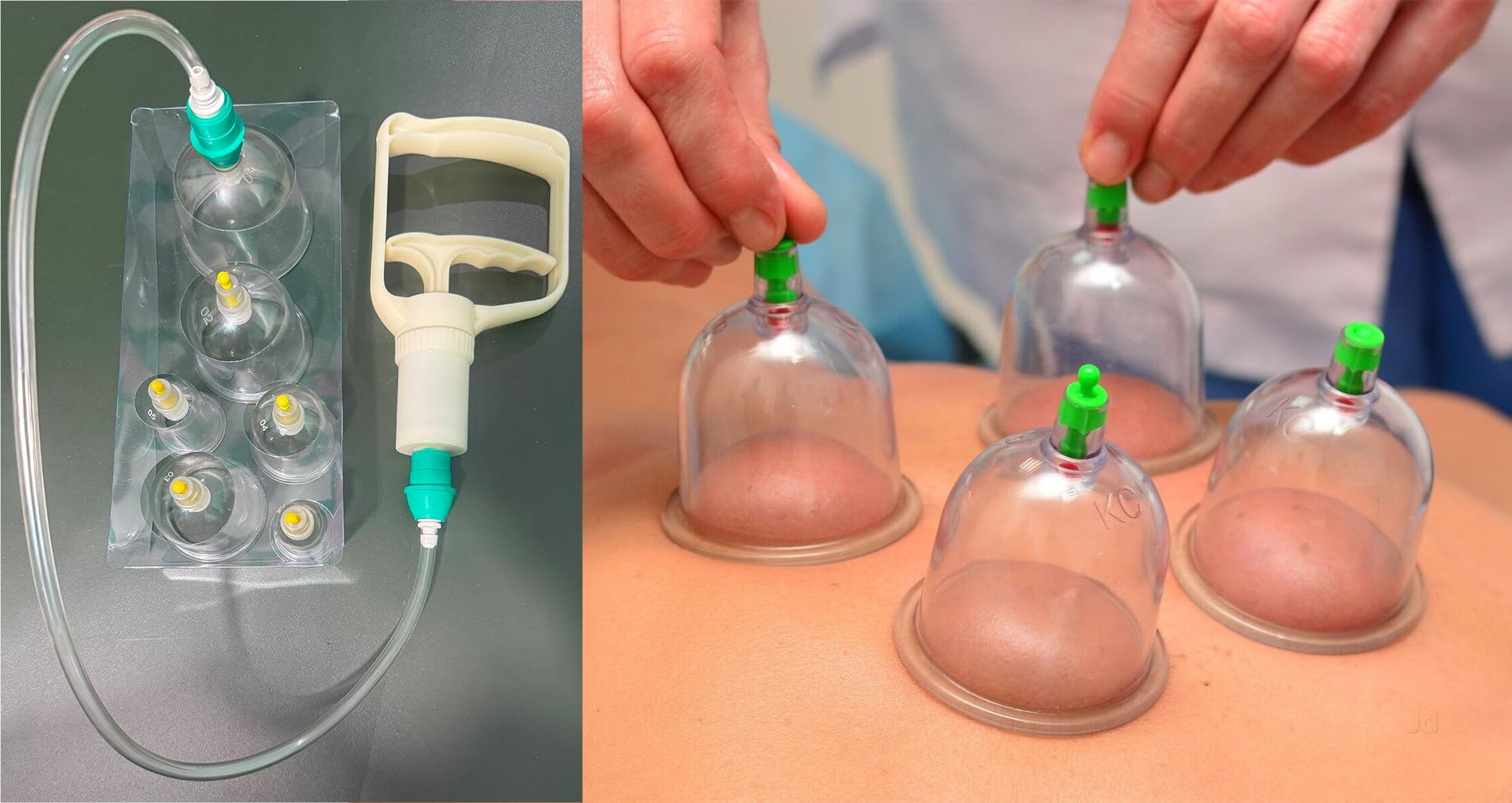 HIJAMA Cupping Kit 6 Pcs Vacuum Cupping Set for Health Care Portable Body Relaxation Massager & Manual Therapy Cups for Pain Relief Magnetic Traditional Chinese Therapy Cupping,Transparent