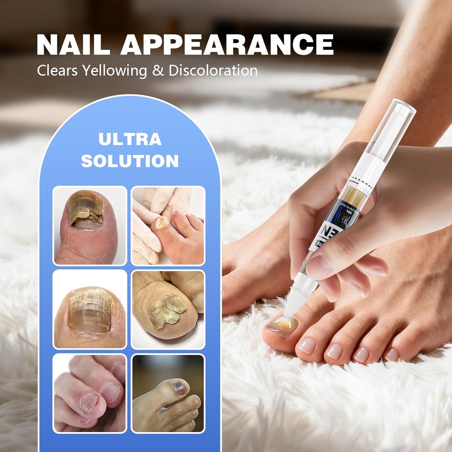 Toe Fungus Treatment for Toenail & Foot Spray - Extra Strength Smelly Feet Kit for Toenails and Fingernails, 6-in-1 System (1 Preventative Spray + 5 Toenail Fungus Pens)