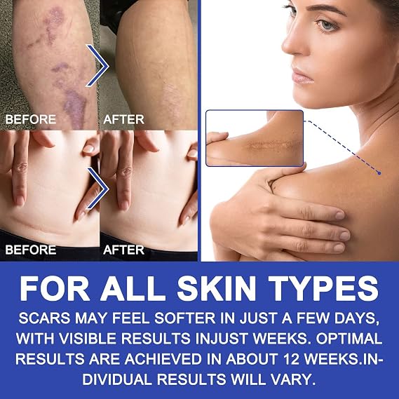 New Transparent Silicone Scar Sheets(1.6 x 120Inch - 3M),Away Scar Tape,Scar Strips, Reusable, Professional Scar Removal Sheets for C-Section, Surgery, Burn, Keloid, Acne et, Scar Patch.