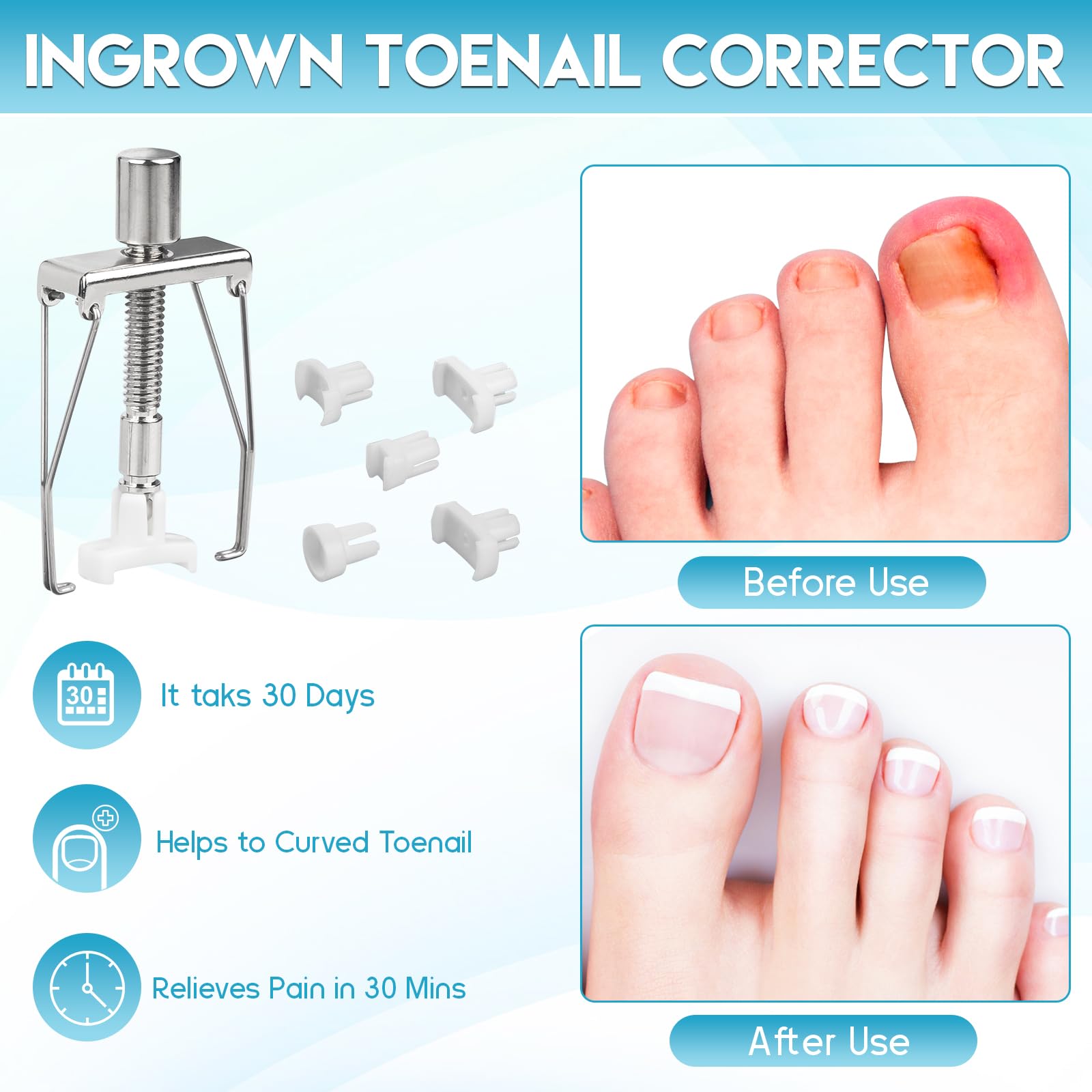 Kit de eliminación de uñas encarnadas, kit de herramientas profesional de uñas encarnadas que incluye gotas correctoras de uñas encarnadas, parche corrector, cortaúñas y herramientas de pedicura para 7
