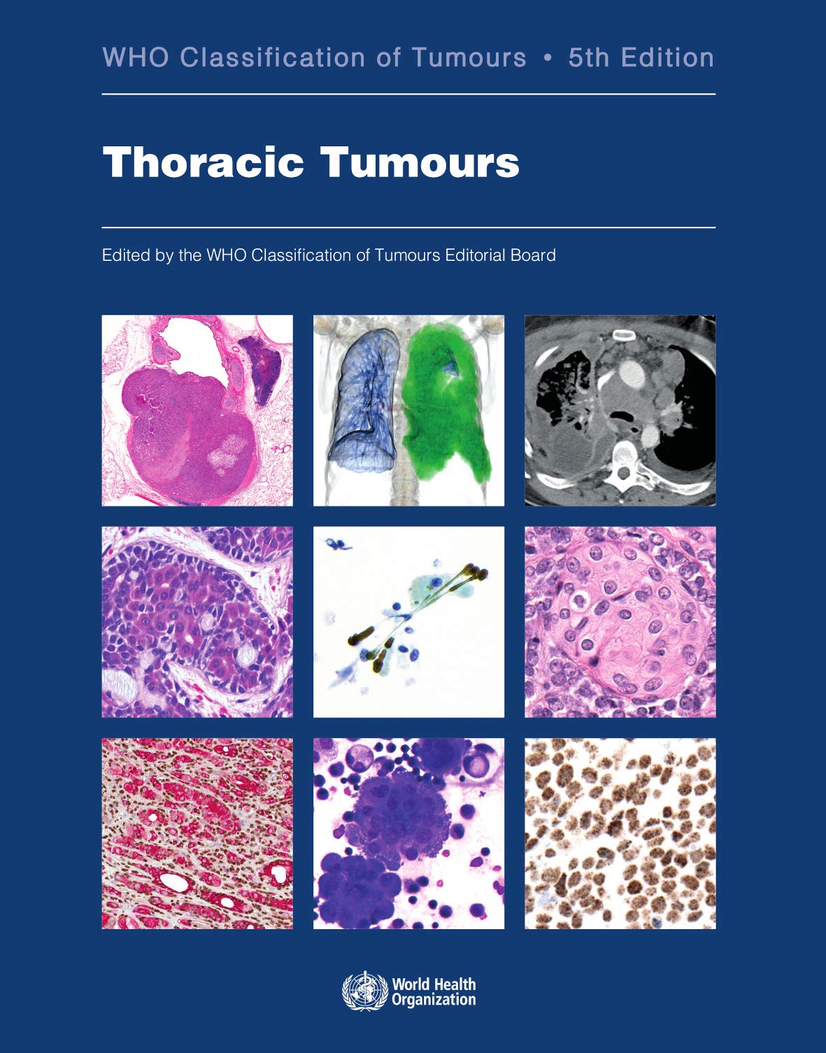 World Health Organization Thoracic Tumours: Who Classification of Tumours