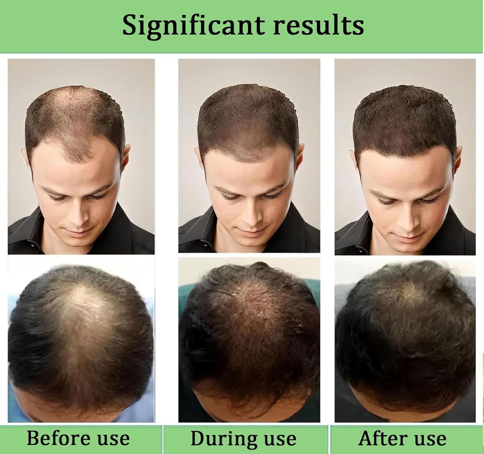 Système de repousse des cheveux Alphainfuse, traitement avancé de croissance des cheveux, sérum de croissance des cheveu-x micro-aiguilles, traitement pour plus épais, renforce les racines (1PC)