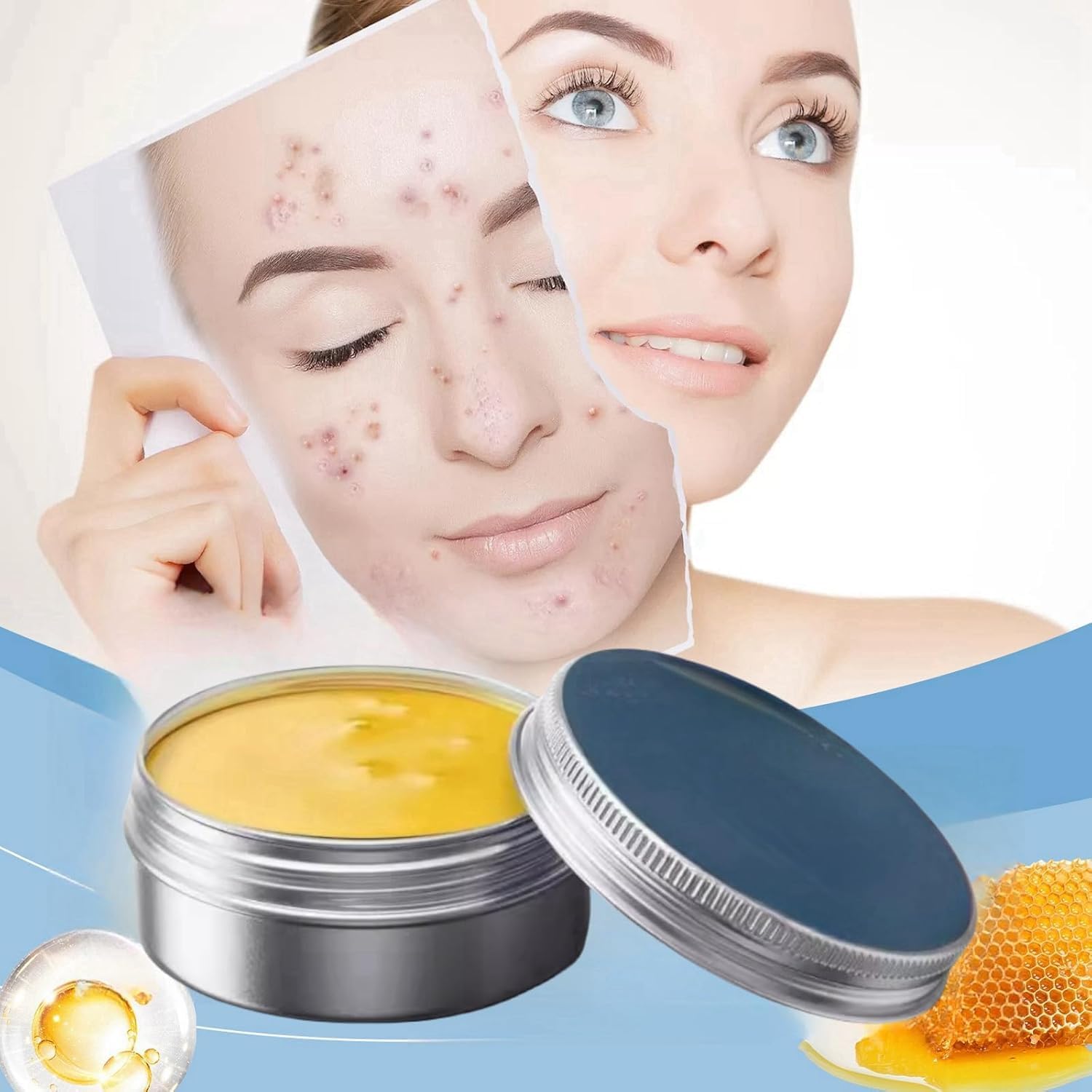 3Pcs Norse Organics Acne & Redness Killer, Norse Organics Acne Balm, Ultra-Performance Skincare, Acne Remove Skin Care Set, Acne Clearing Cream for All Skin Types - Image 3