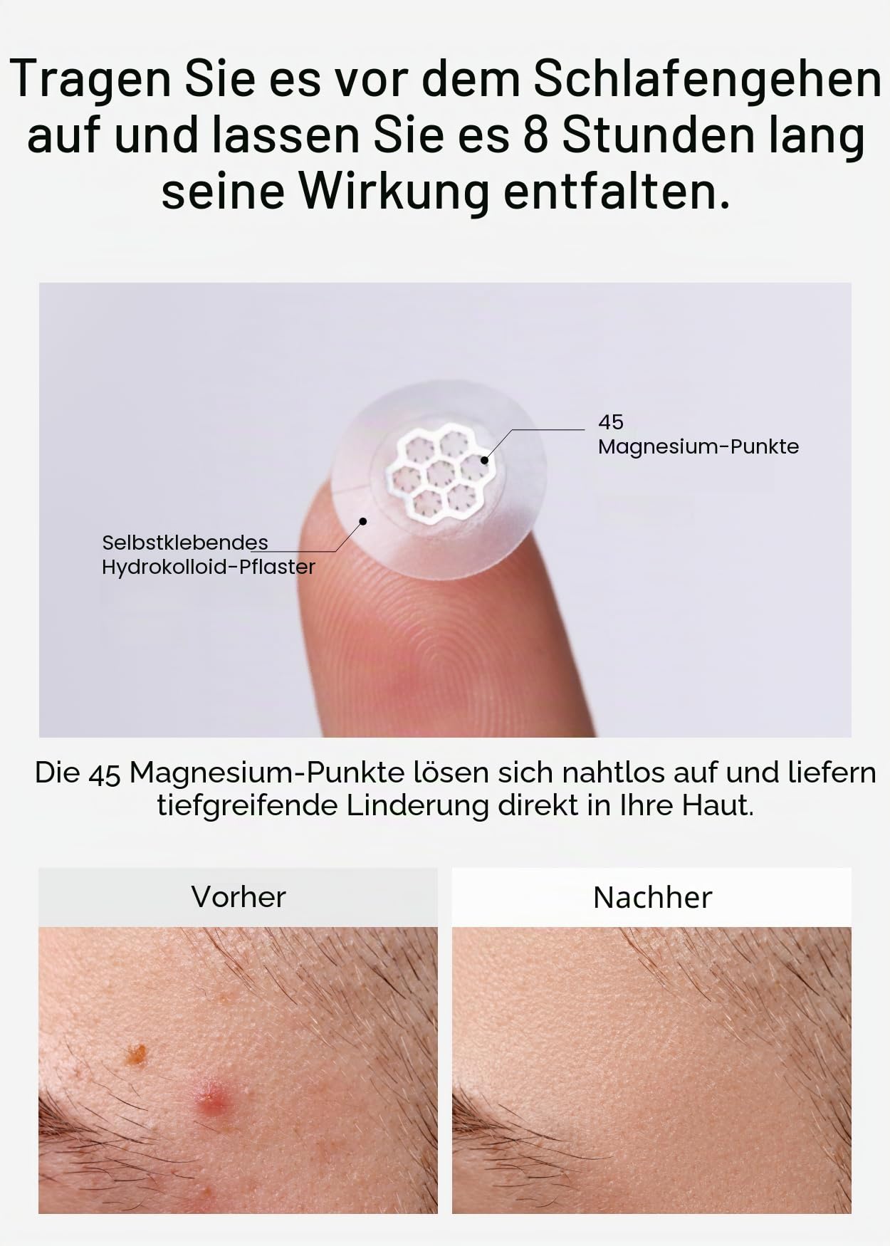 EasyDerm Quick Calming Magnesium Patches - Hydrokolloid Akne Spot Behandlung mit Teebaum & Zika, 10 Pflaster, Zit Sticker, TikTok Viral Blemish Patch