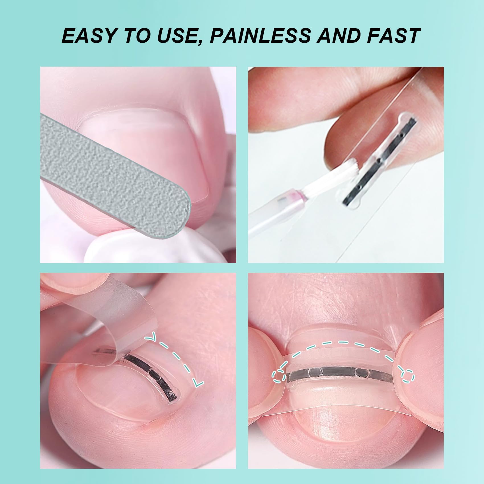 Ensemble Professionnel Pour la Correction des Ongles Incarnés : Patchs de Correction des Ongles et Outils Efficaces Pour Ongle Incarné