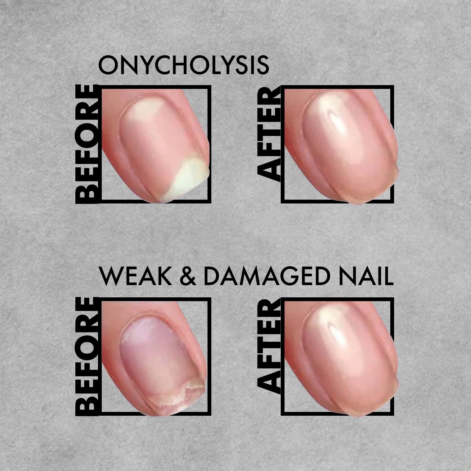 3-in-1 Nagelpflege zur Vorbeugung von Pilzinfektionen, Anti-Onycholyse, EMI Antifungal, 9 ml