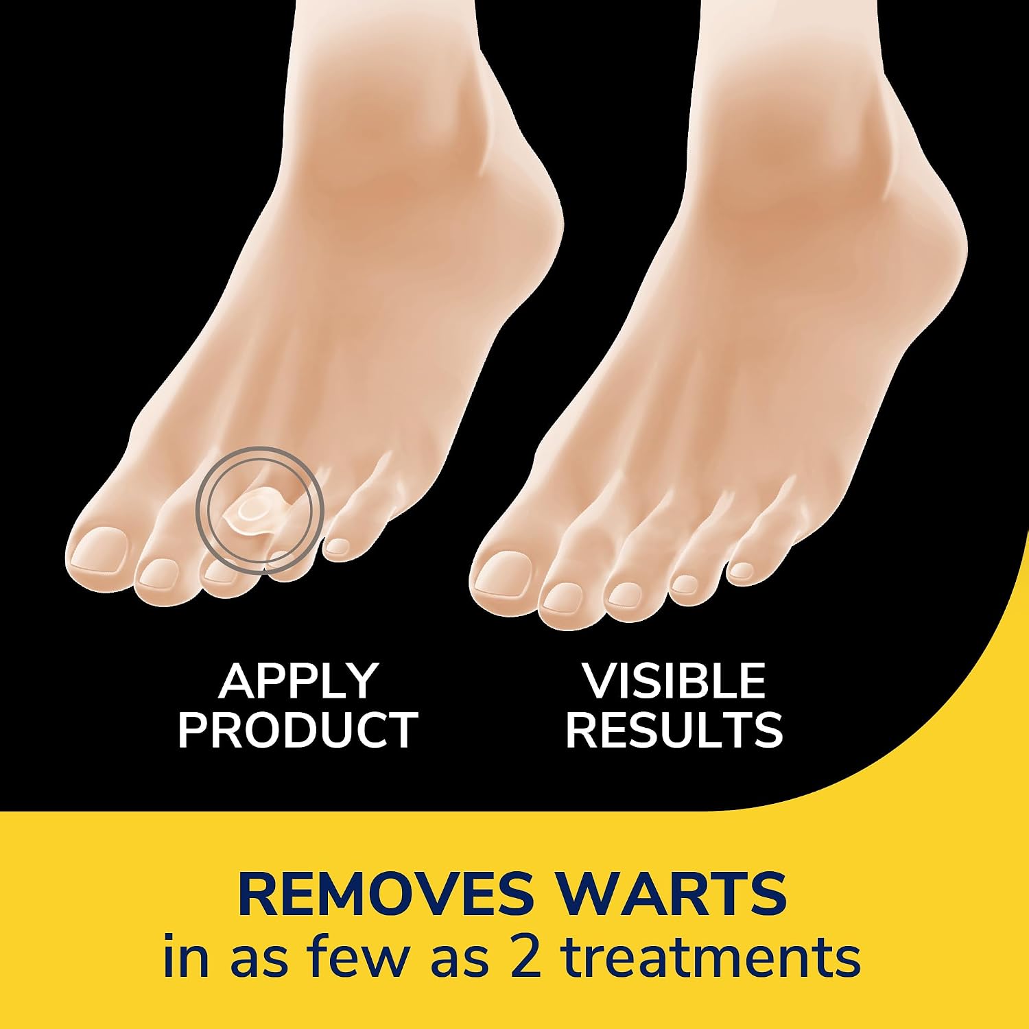 Dr. Scholl's ONE-Step WART REMOVERS, 14 ct // Removes Warts in As Few As 2 Treatments, Maximum Strength, Easy One-Step Application, Stays on All Day