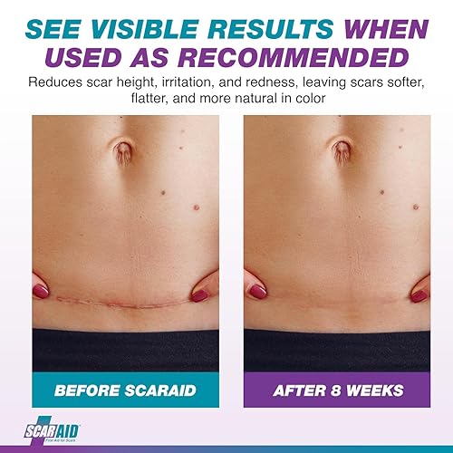 Miniatura 4 de Láminas de gel de silicona de grado profesional clínicamente probadas, reutilizables, lavables y personalizables para cicatrices más suaves