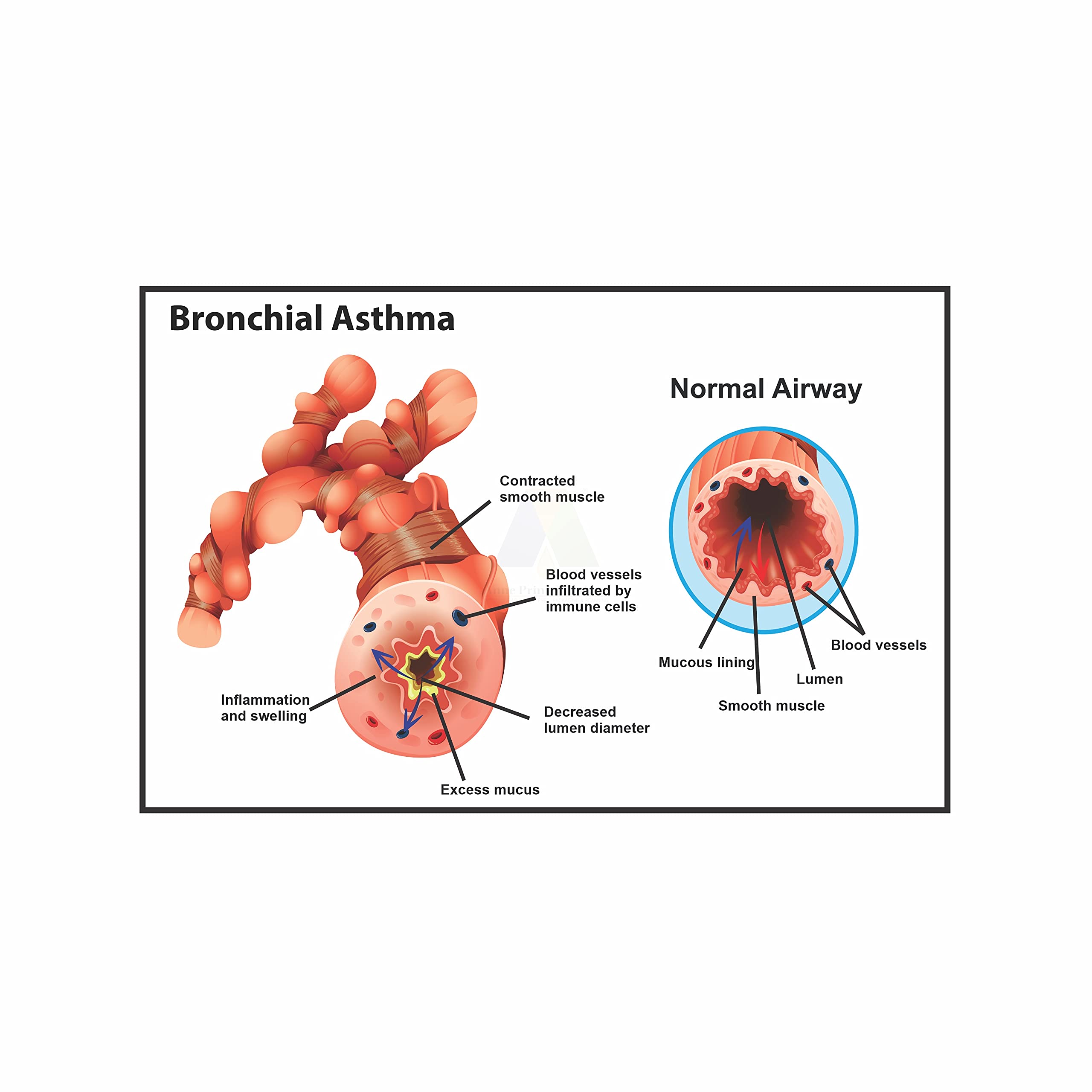 Anne Print Solutions® Bronchial asthma Poster (Without Frame) For Hospital Poster | Clinic Poster Pack Of 1 Pcs Size 13 Inch* X 19 Inch*
