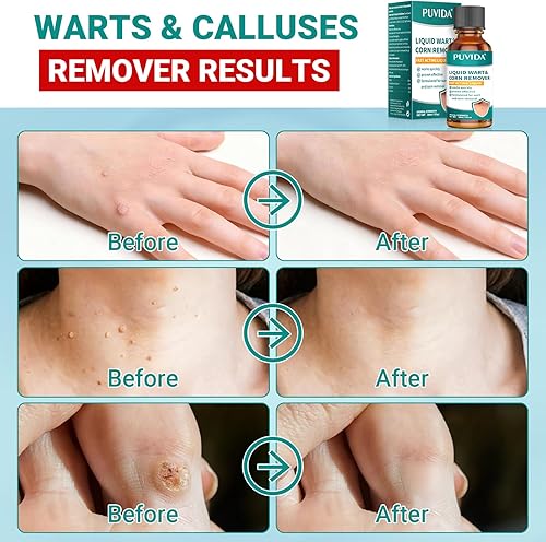 Miniatura 5 de Kit de eliminación de marcas cutáneas de acción rápida  17% ácido salicílico removedor de verrugas congelación para dedos de los pies, verrugas