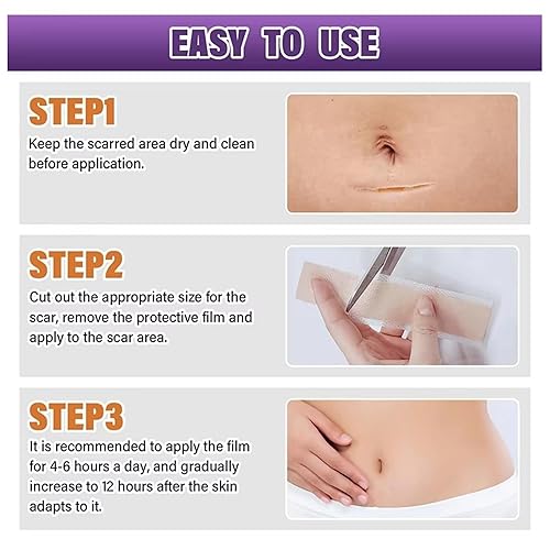 Miniatura 5 de Bokor Hojas de silicona para cicatrices, cinta de silicona para cicatrices quirúrgicas, parches de eliminación de cicatrices con tratamiento de
