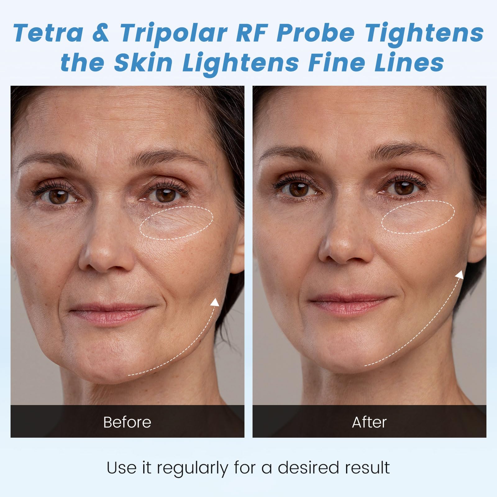 Radiofréquence Visage 4 en 1, 40K Lipocavitation Radiofrequence Corps Masseur Anti Cellulite Appareil Amincissant Raffermissant (blanc)