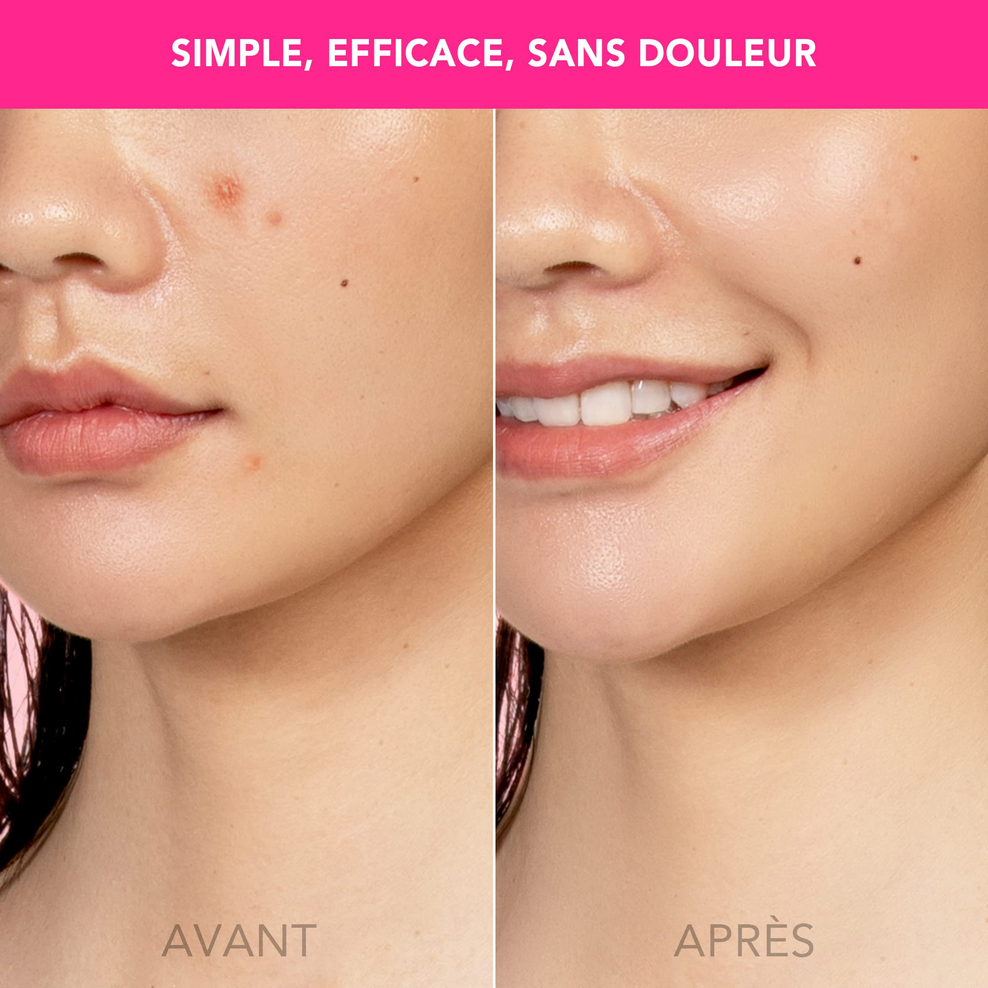 FOREO ESPADA Appareil traitement de l'acné par lumière LED bleue, traite les cicatrices d'acné, élimine les boutons et l'acné, nettoie et purifie la peau, silicone de qualité médicale.