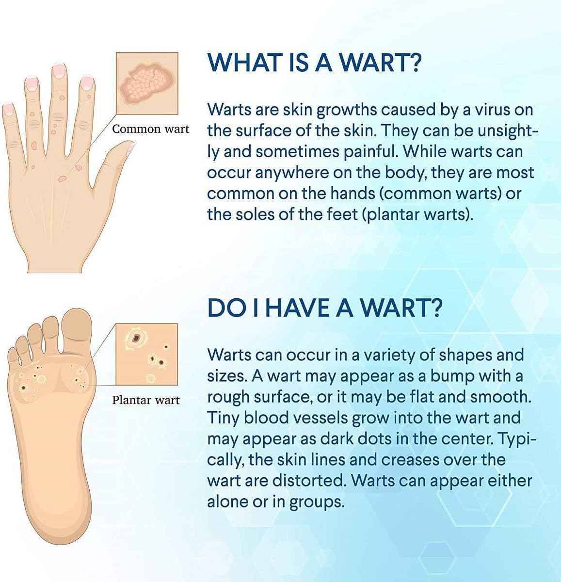 Wart Remover- Maximum Strength Wart Remover Liquid- Effectively and Painlessly Removes Common and Plantar Warts- Bonus Cotton Swabs by Evagloss Plus : Health & Household