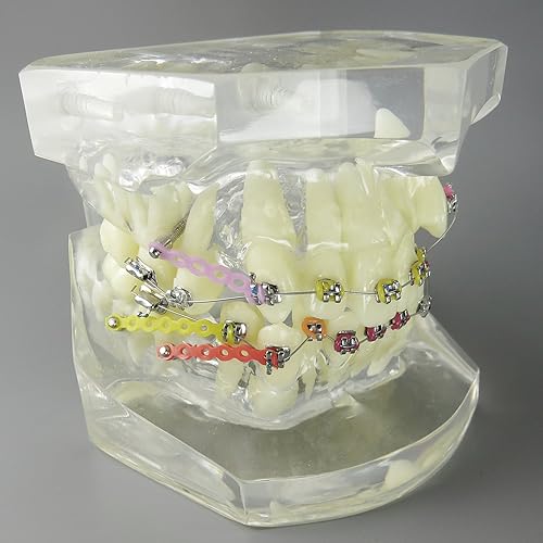 Miniatura 2 de Modelo dental de los dientes del tratamiento de ortodoncia de la maloclusión con los soportes del metal Alambres Cadenas y aros coloridos de los