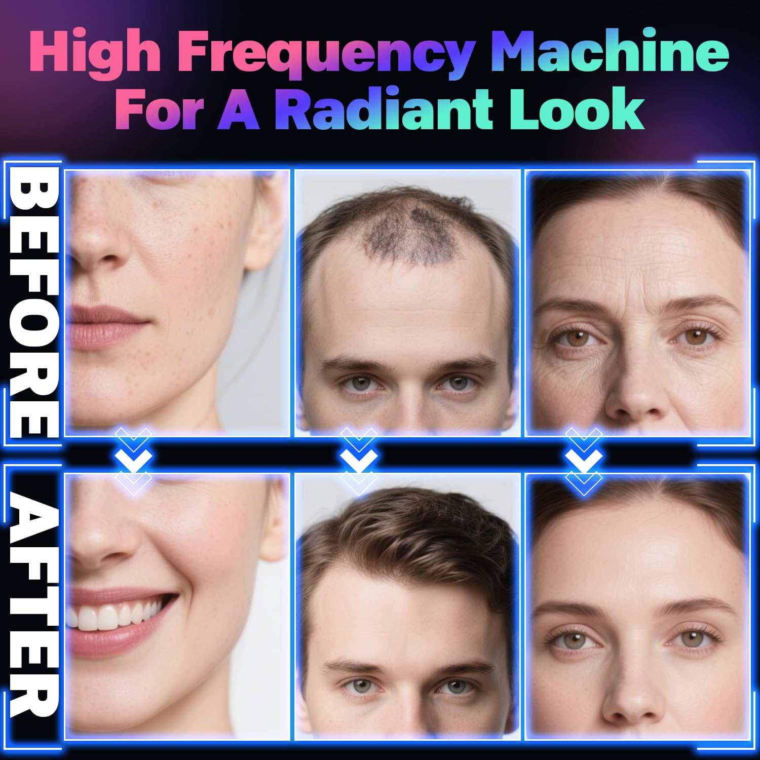 Hochfrequenzstab Gesicht, ROMMQB Argon und Neon-Hauttherapiegerät mit 4 Blauen Lichtröhren, Professionelles Hochfrequenzgerät für Haarwuchs, Akneentfernung, Home Hochfrequenz gerat