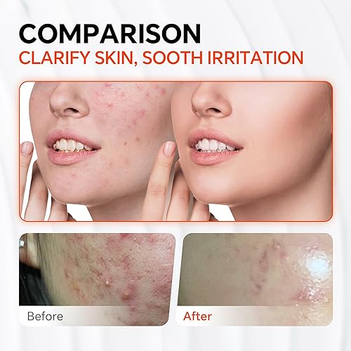 Miniatura 3 de Crema de suero de ácido azelaico al 10%, tratamiento de acné rosácea, minimiza los poros, removedor de manchas oscuras, niacinamida, resultados