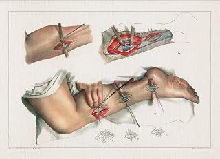 Anatomy LIGATURE TIBIA ARTERY print SRA3 12x18 conqueror laid paper