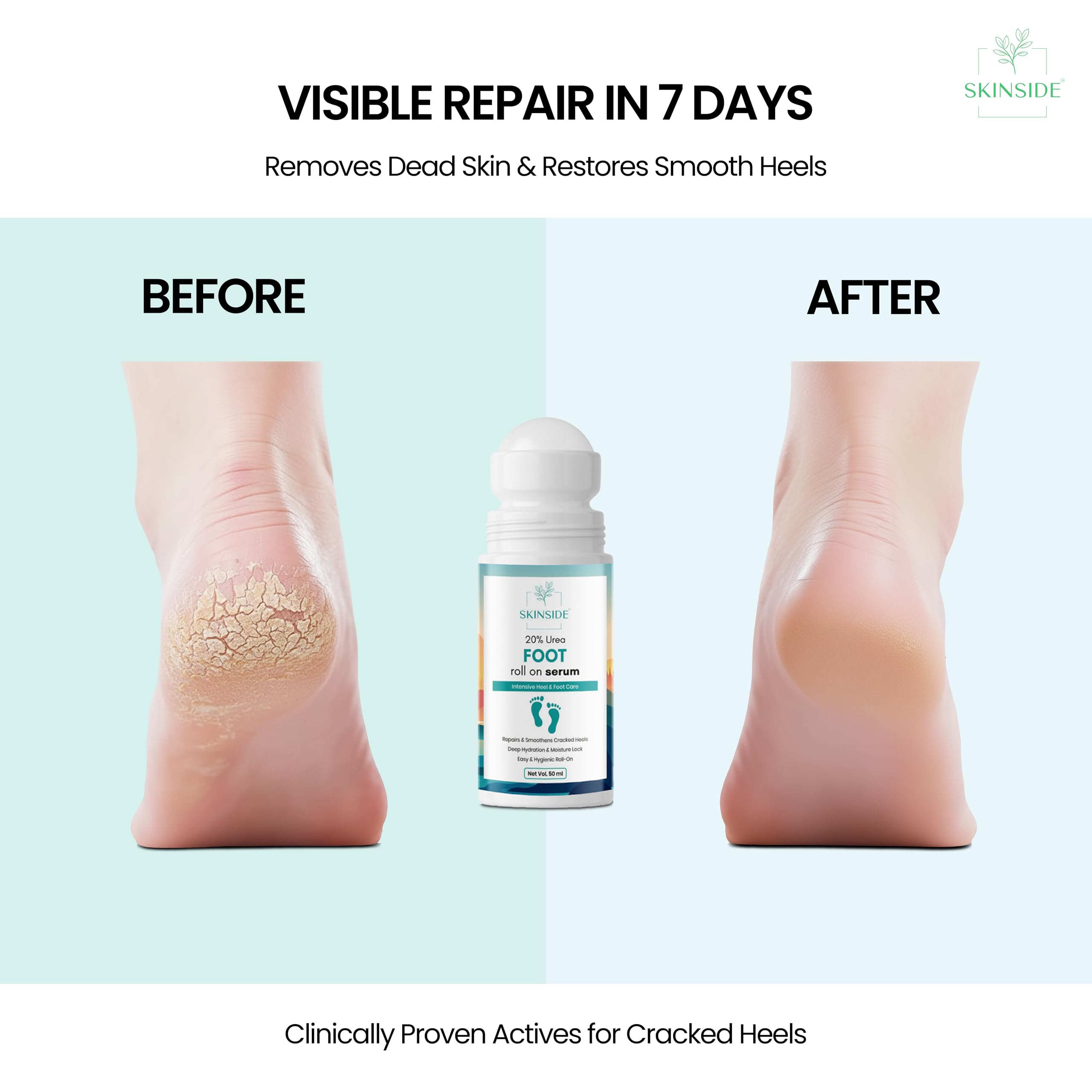 SkinSide 20% Urea Foot Roll On for Cracked Heels & Dry Feet | Lactic Acid + Salicylic Acid | Callus Remover & Heel Repair Serum | Softens Rough Skin | Non-Sticky Formula | 50ml - Image 4 thumbnail
