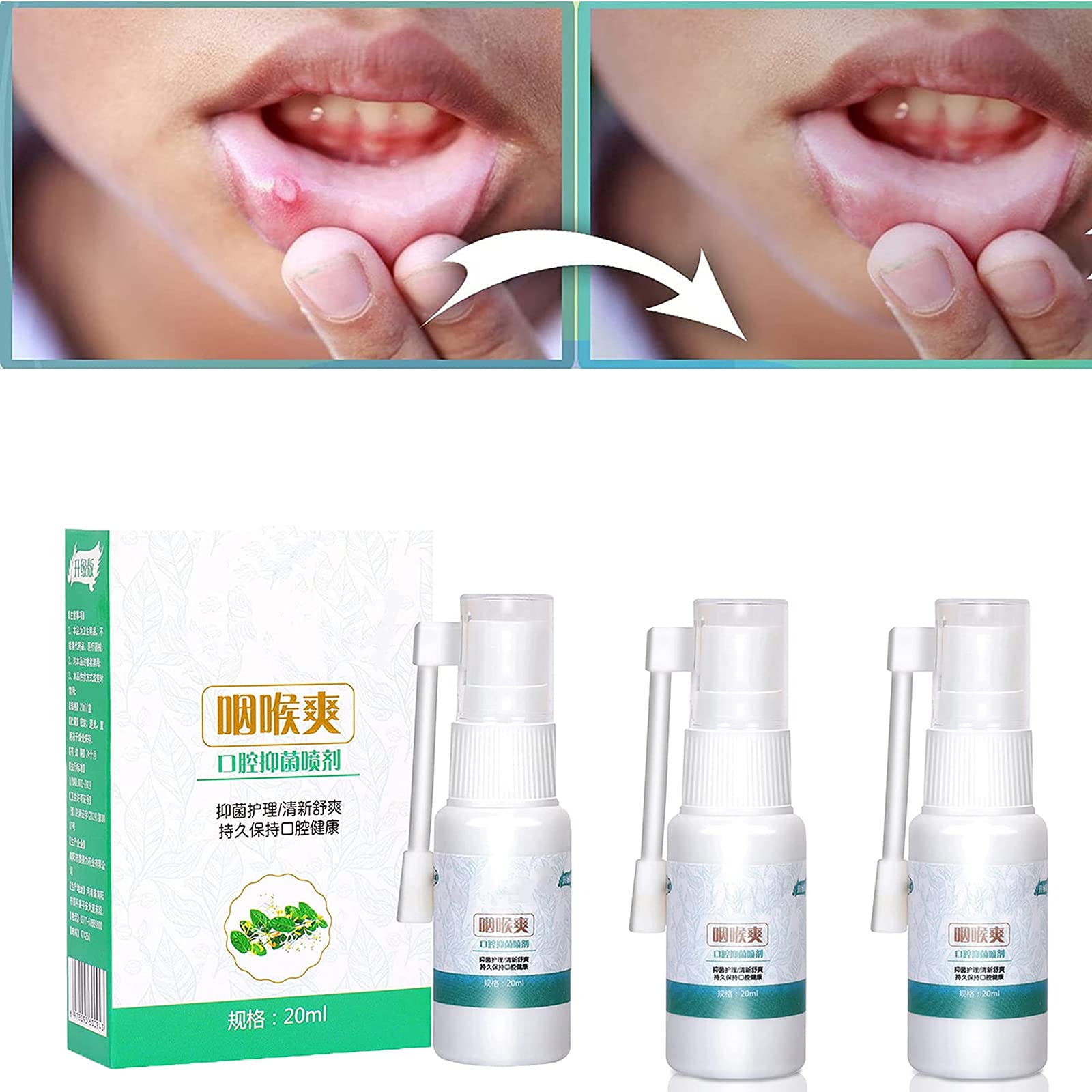 Buy Mouth And Throat Sore Oral Spray,Spray Mouth Ulcer ,Sore Throat