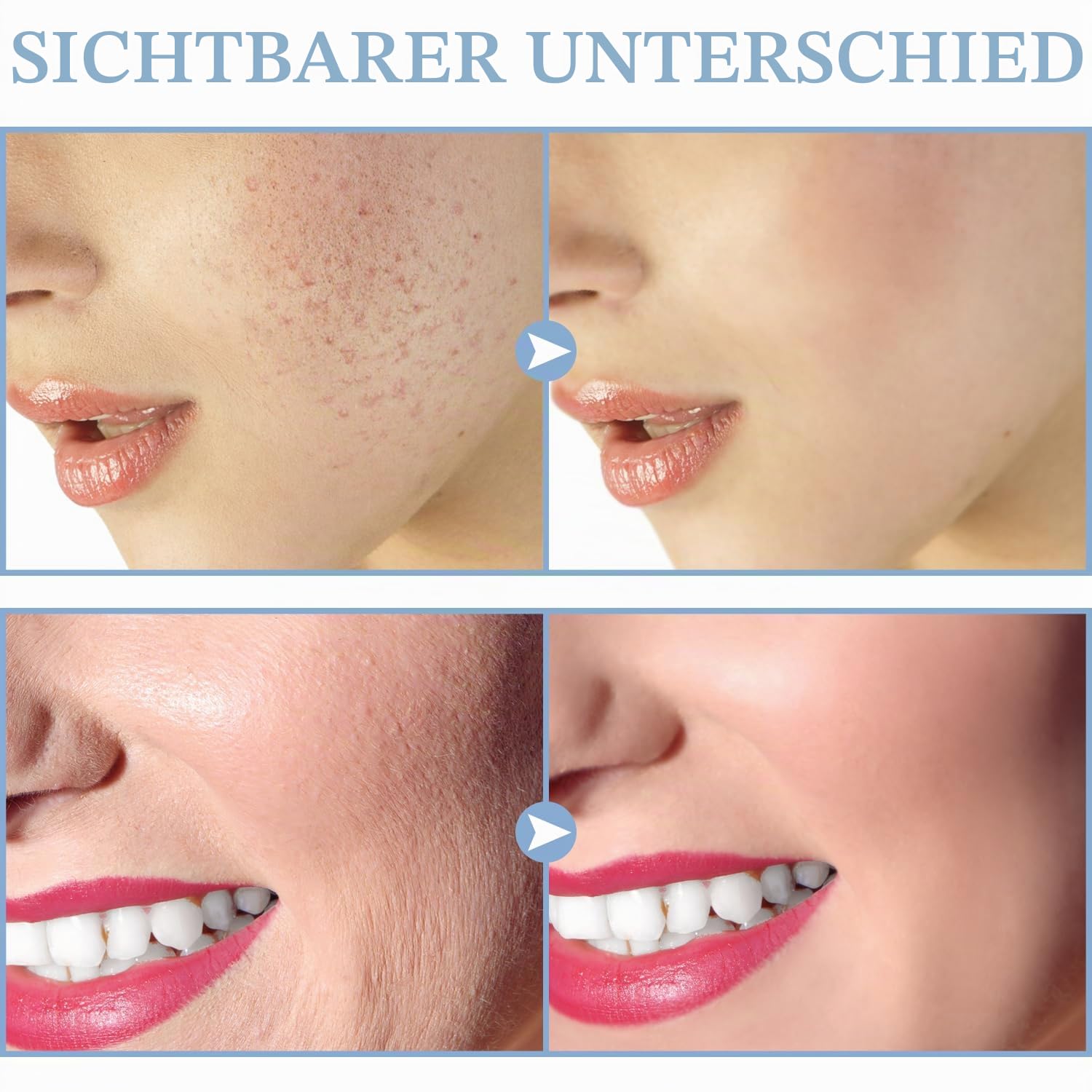TUMAKOU Hochfrequenzstab Gesicht Hauttherapiegerät mit 4 Neon Stab Aknebehandlung Hautstraffung Faltenreduzierung