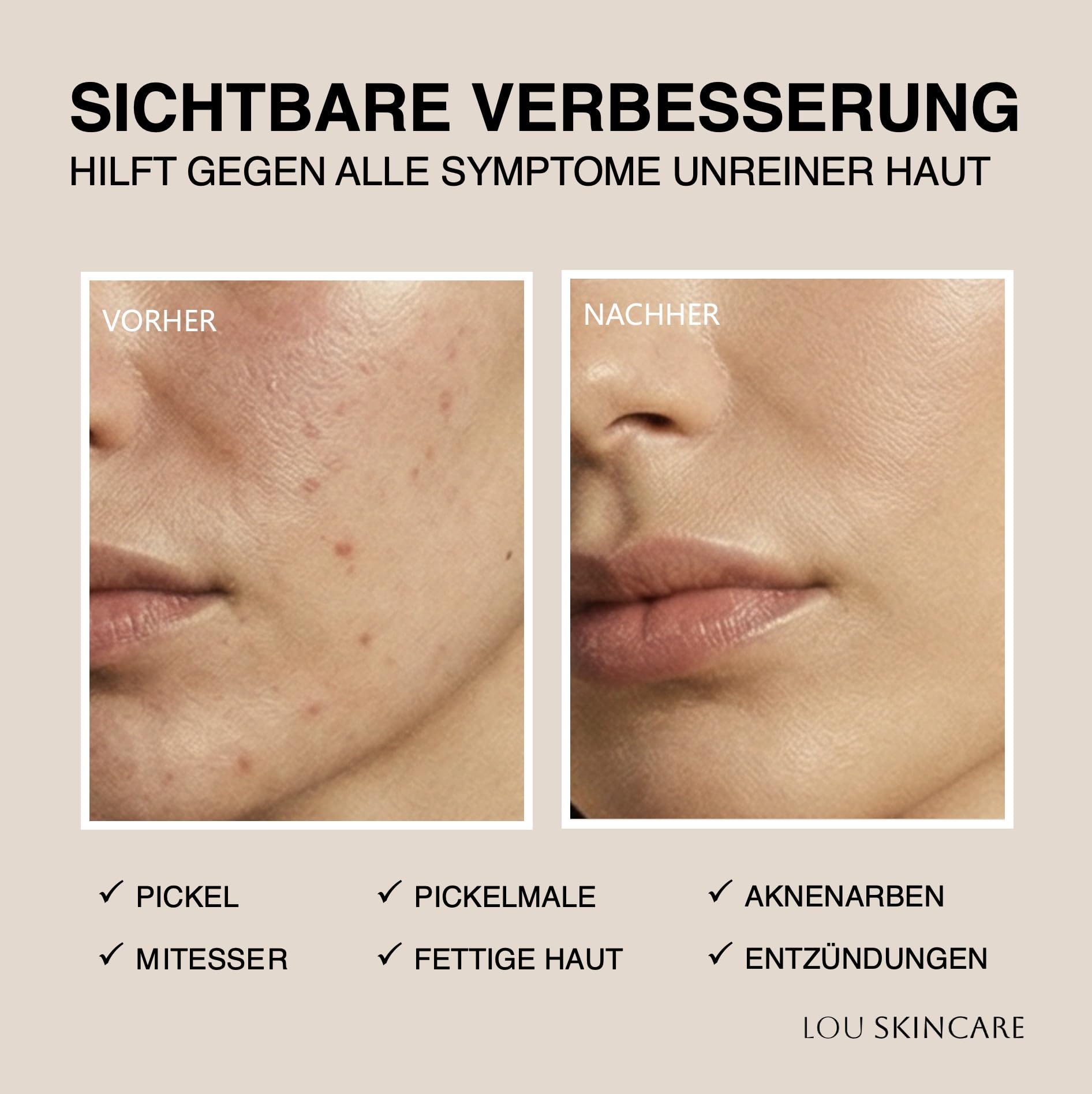 lou skincare purifying serum - Gesichtsserum mit Hanf, Teebaum und Lavendel, für unreine und empfindliche Haut, 30ml