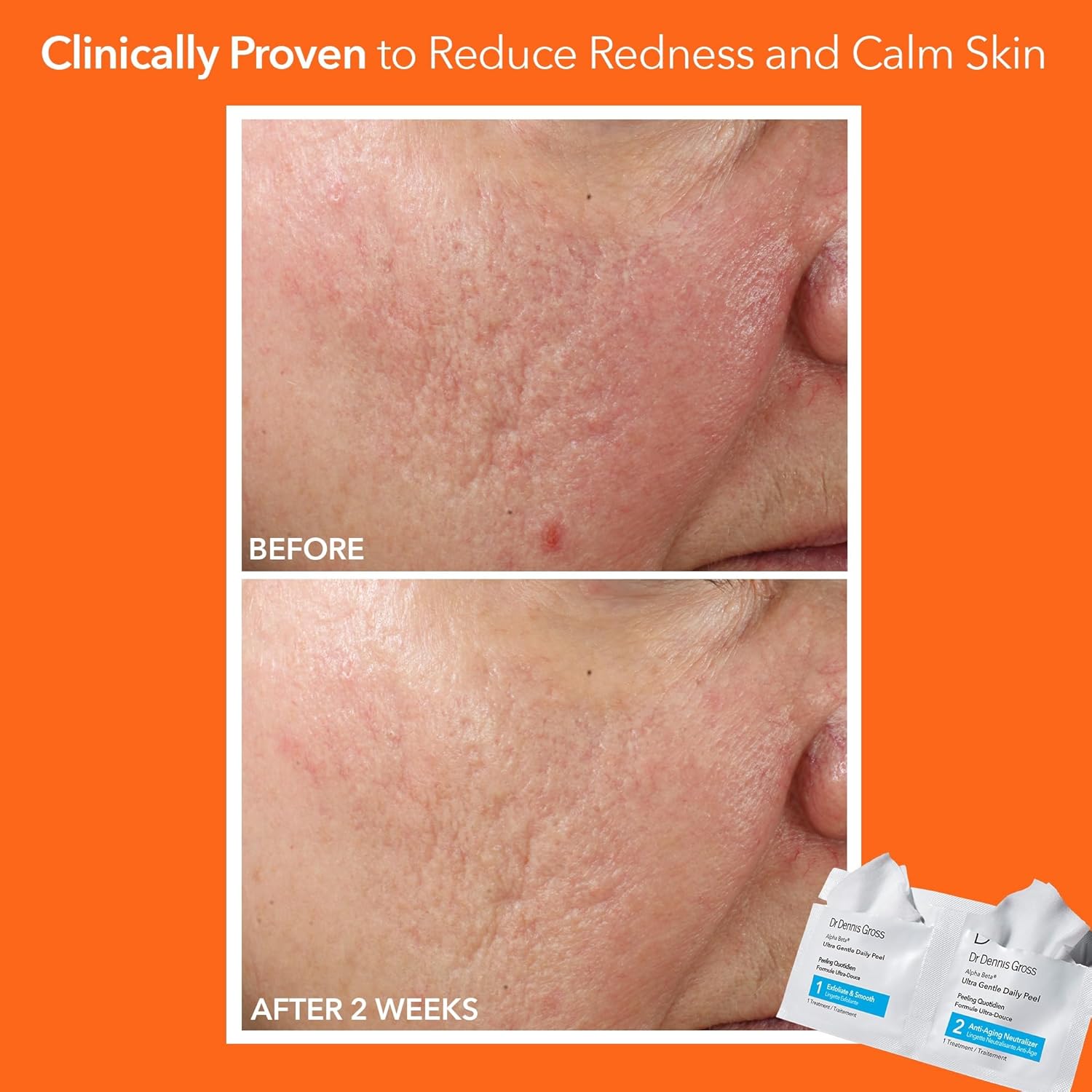 Dr. Dennis Gross Alpha Beta Ultra Gentle Daily Peel: for Dehydrated or Sensitive Skin, Uneven Tone or Texture, Fine Lines or Enlarged Pores (30 Treatments)