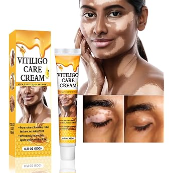 Vitiligo Cream and White Spots Repigmentant for White Spots and Skin Care