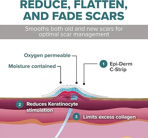 Miniatura 4 de Epiderm - Tiras de gel de silicona para el cuidado de cicatrices, sección C, cinta de abdominoplastia y cicatrices de cirugía cardíaca, tiras
