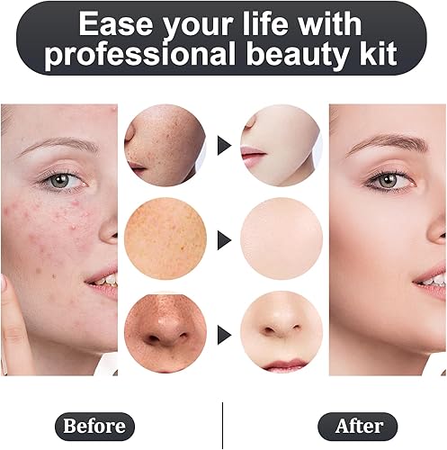 Miniatura 6 de Juego de herramientas de extracción y extracción de espinillas y acné de acero inoxidable, elimina rápida y de forma segura el acné, puntos negros,