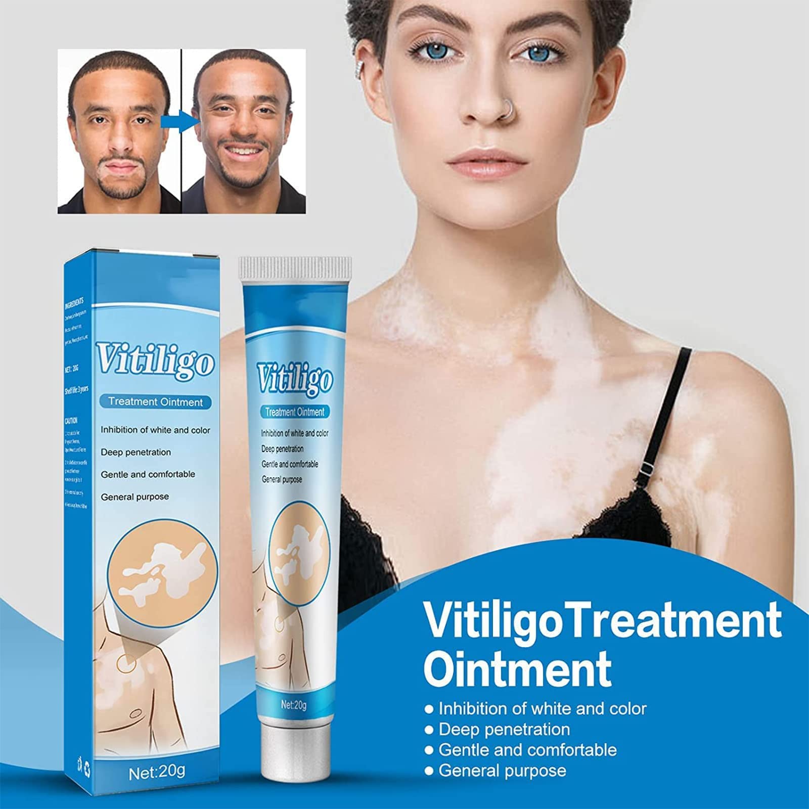 Crème Réparatrice Vitiligo - Élimine Les Taches Blanches De La Peau, 20 Ml, Naturelle, Fabriqué En Thaïlande