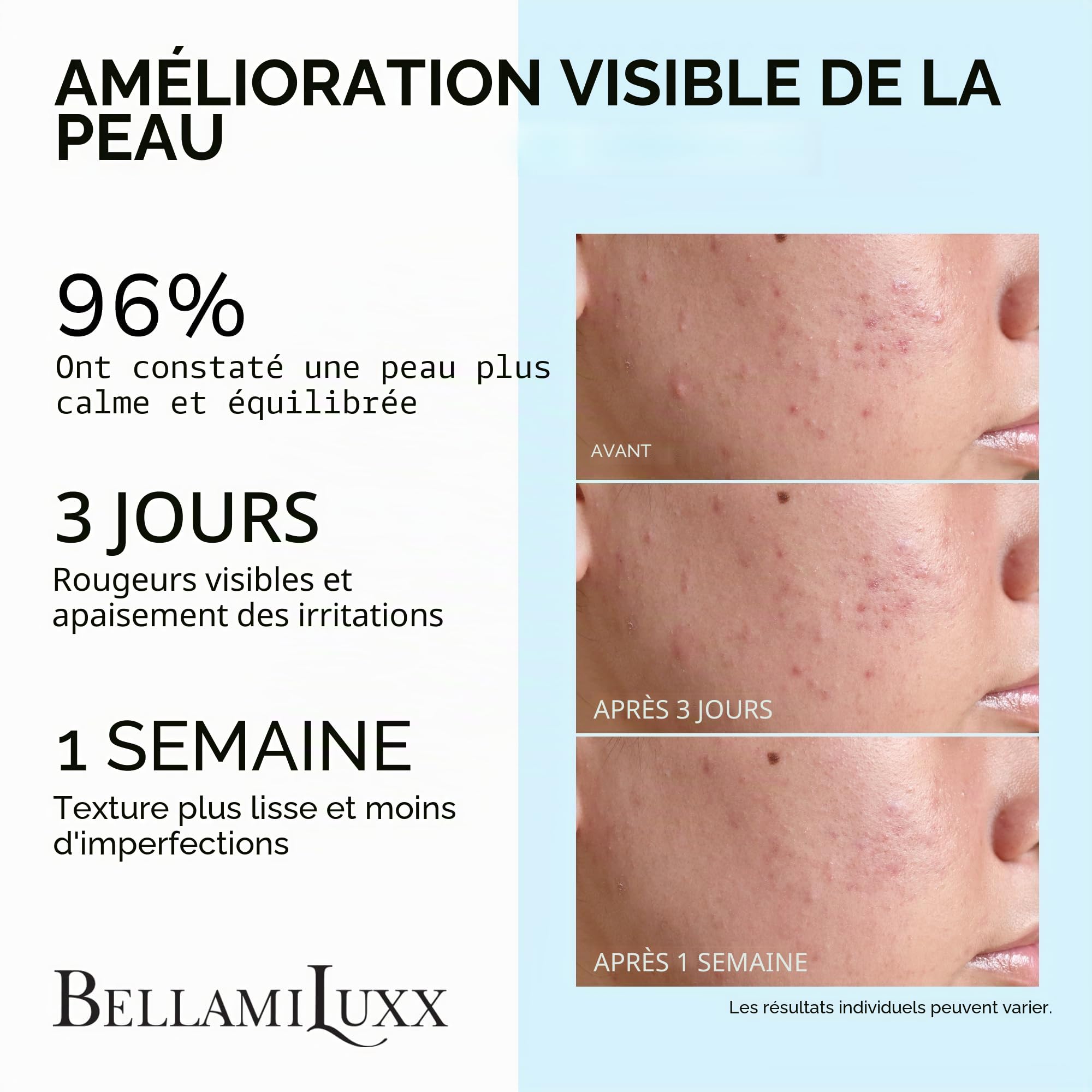 BellamiLuxx Traitement cystique de l'acné pour le visage : crème de traitement de l'acné hormonal pour adolescents et adultes - Acide salicylique et huile d'arbre à thé - Anti-acné hydratant réduit