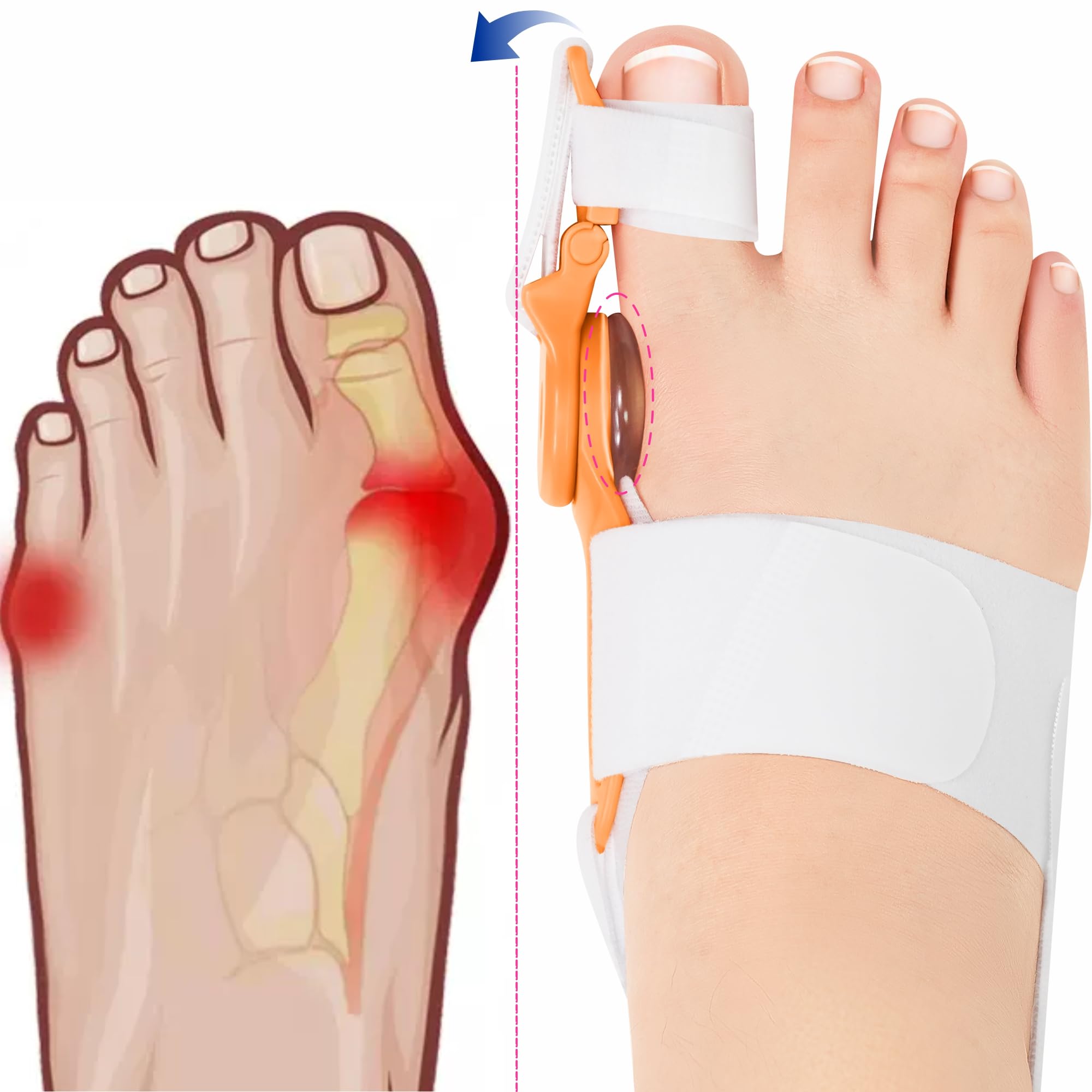 Ashomie Bunion Corrector, Big Toe Separator Pain Relief,Bunion Splint,Adjustable Day Night Support for Men and Women 2PC