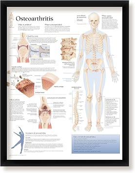 Framed Medical Poster Osteoarthritis 22"x28" Wall Diagram Educational Informational Doctors Office Chart