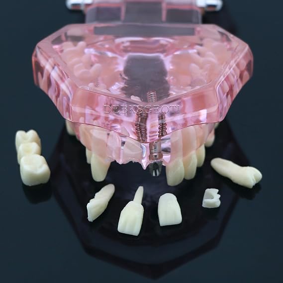 Typodont Implant Dental Repair Model Universal Restoration Teeth Oral Prosthesis Pathology Bridge False Tooth Demo for Teach Study M2001 Pink