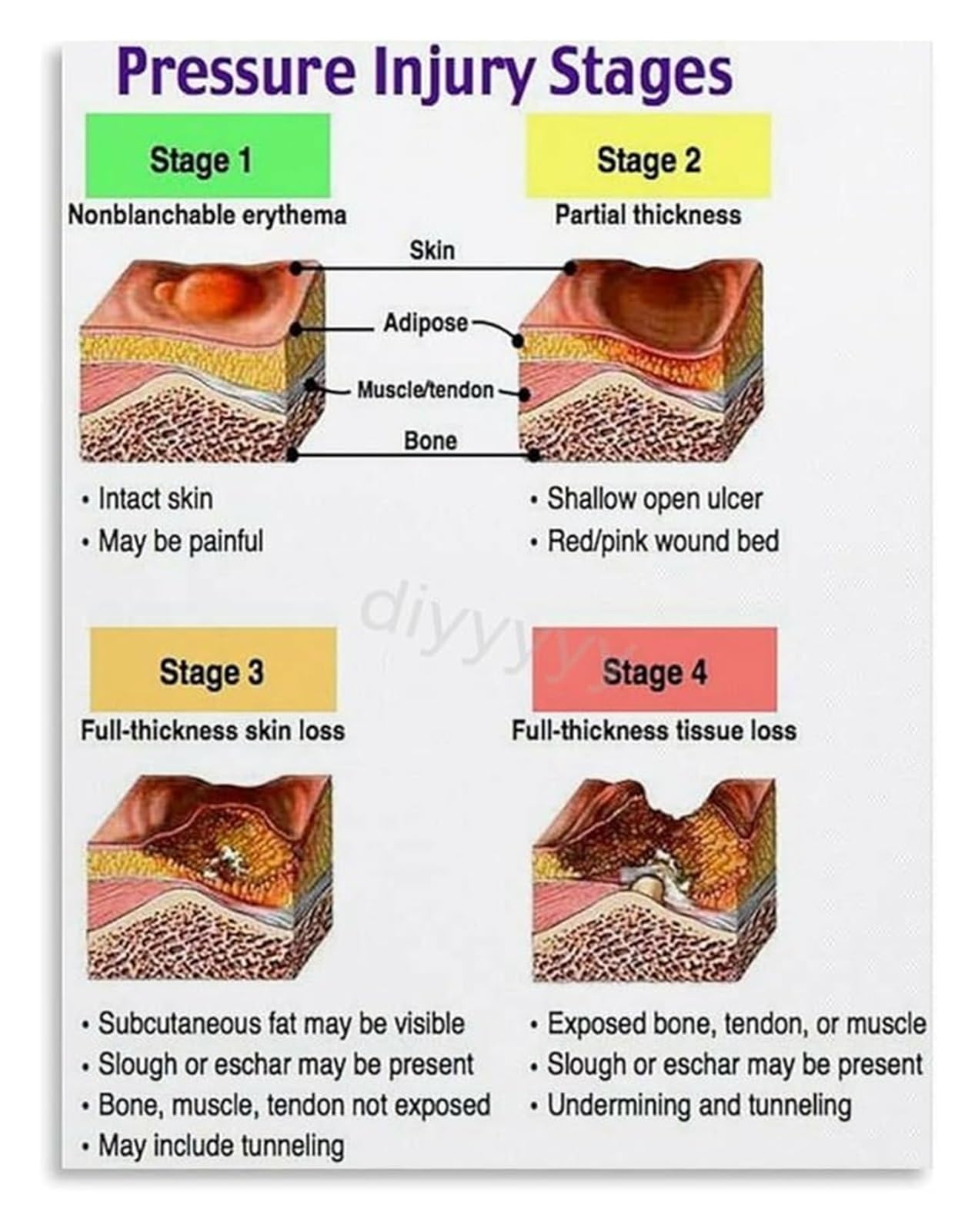 FNYUVNFAF Healthcare Reference Canvas Painting Pressure Ulcer Staging Chart Wall-Art Unframed,08x12inch(20x30cm)