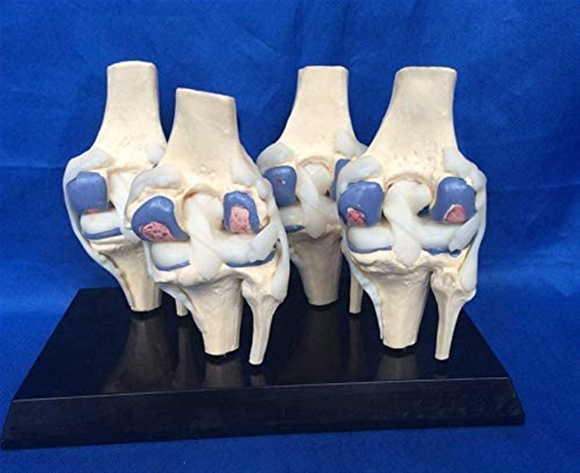 Buy WECDS-E Anatomy Model, Anatomy Human Lesion Knee Joint Model - 4 ...